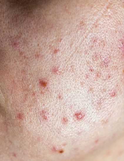 Skin with small whiteheads and clogged pores on the cheek area under natural light