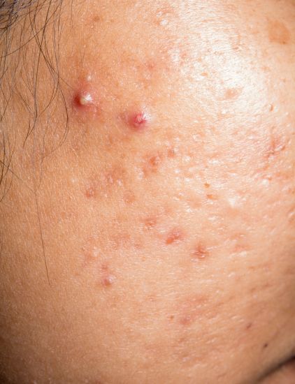 Close-up of a woman’s face with red, inflamed acne on both cheeks