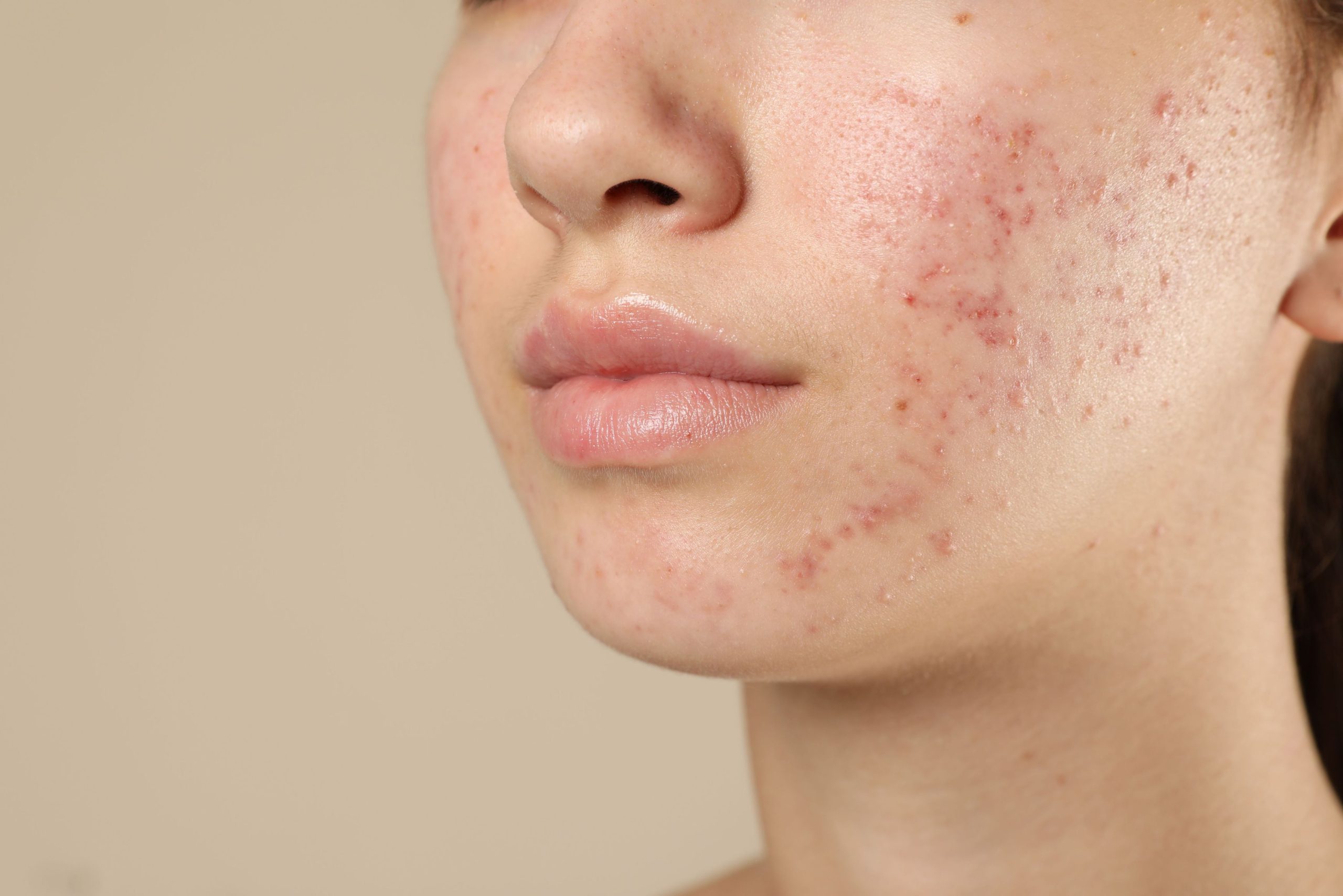 Close-up of inflamed acne and clogged pores on facial skin
