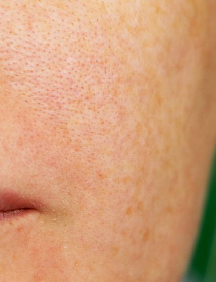 Close-up of a woman with melasma dark spots on her cheeks and forehead under natural light