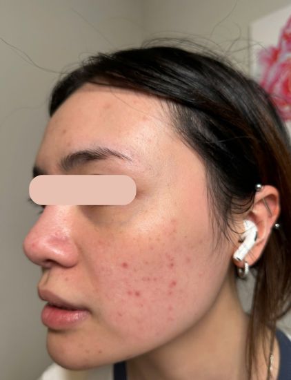 Before acne treatment – client with inflamed breakouts and uneven skin tone