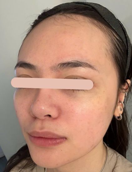 After acne treatment – visibly clearer skin with reduced redness and acne marks