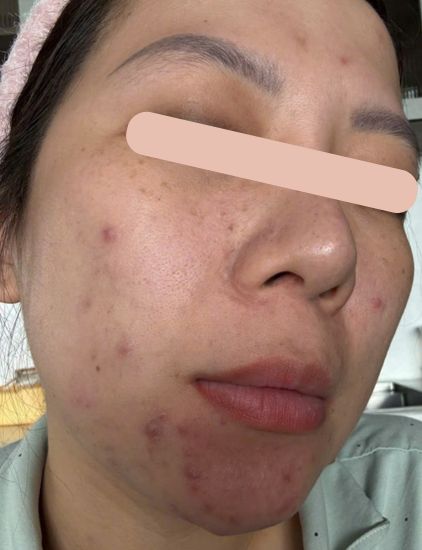 Before acne treatment – close-up of acne-prone skin with clogged pores