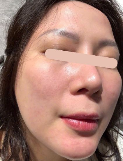After acne treatment – smoother skin texture and improved overall clarity
