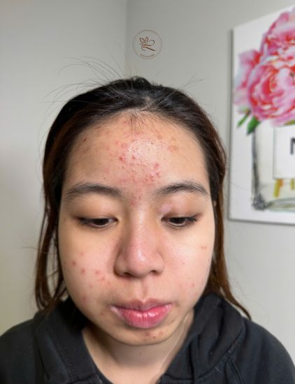 Before and after acne treatment inflamed acne visibly reduced