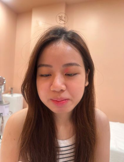 Severe acne improvement after facial program