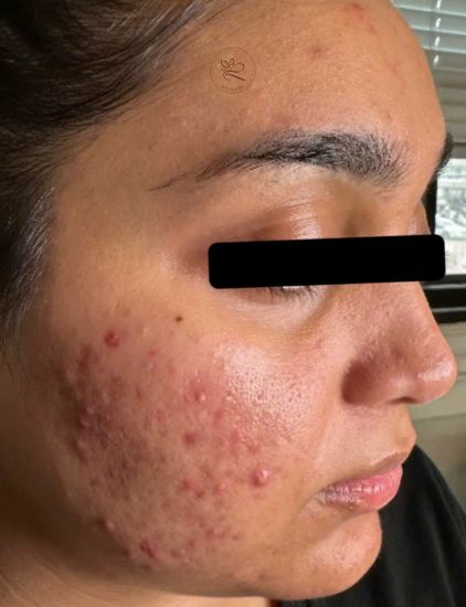acne before