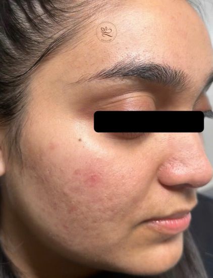 Skin transformation clearer texture post acne treatment