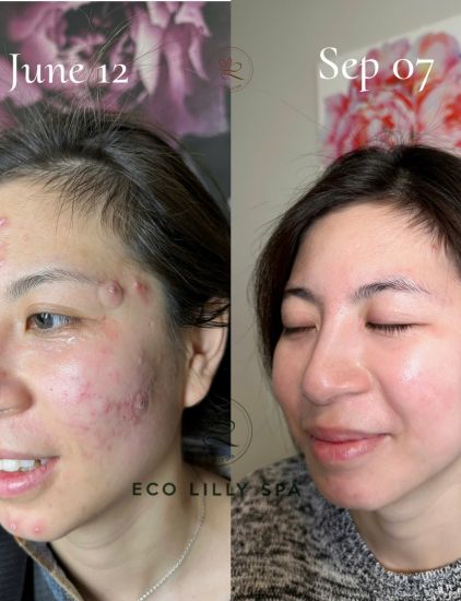 Before-after results of hormonal acne care