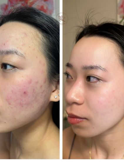 Reduced redness and breakouts after treatment