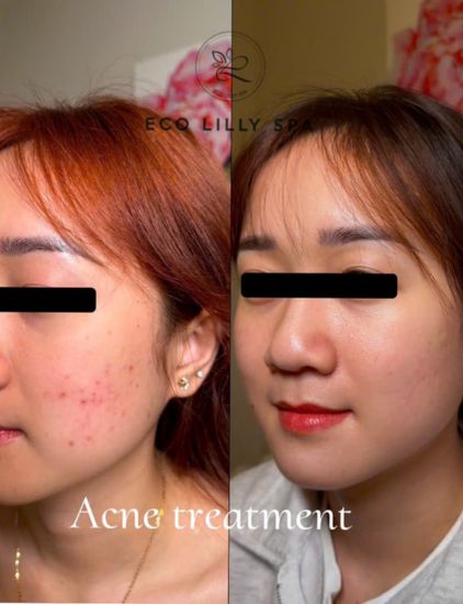 Blackhead and whitehead removal before-after
