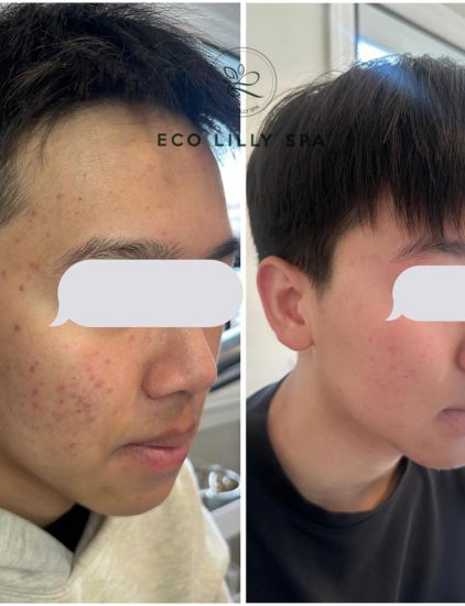 Clearer, smoother skin after Eco Lilly Spa acne program