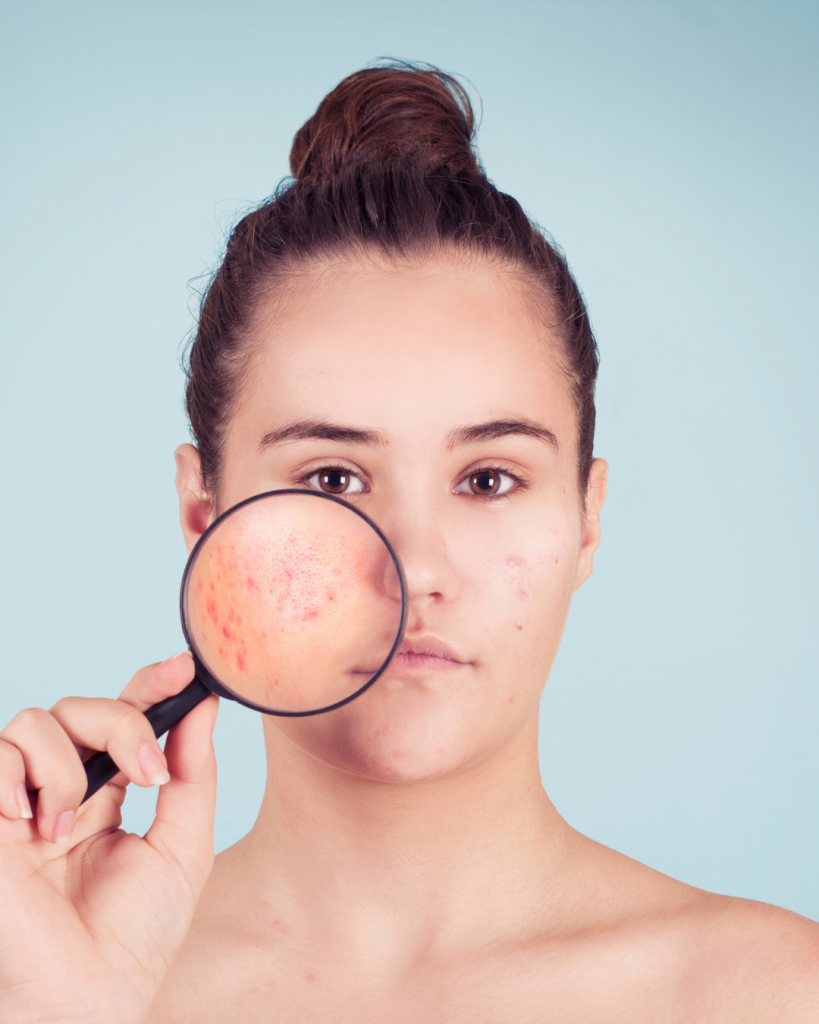 Woman holding magnifying glass highlighting fungal acne and red bumps on cheek.