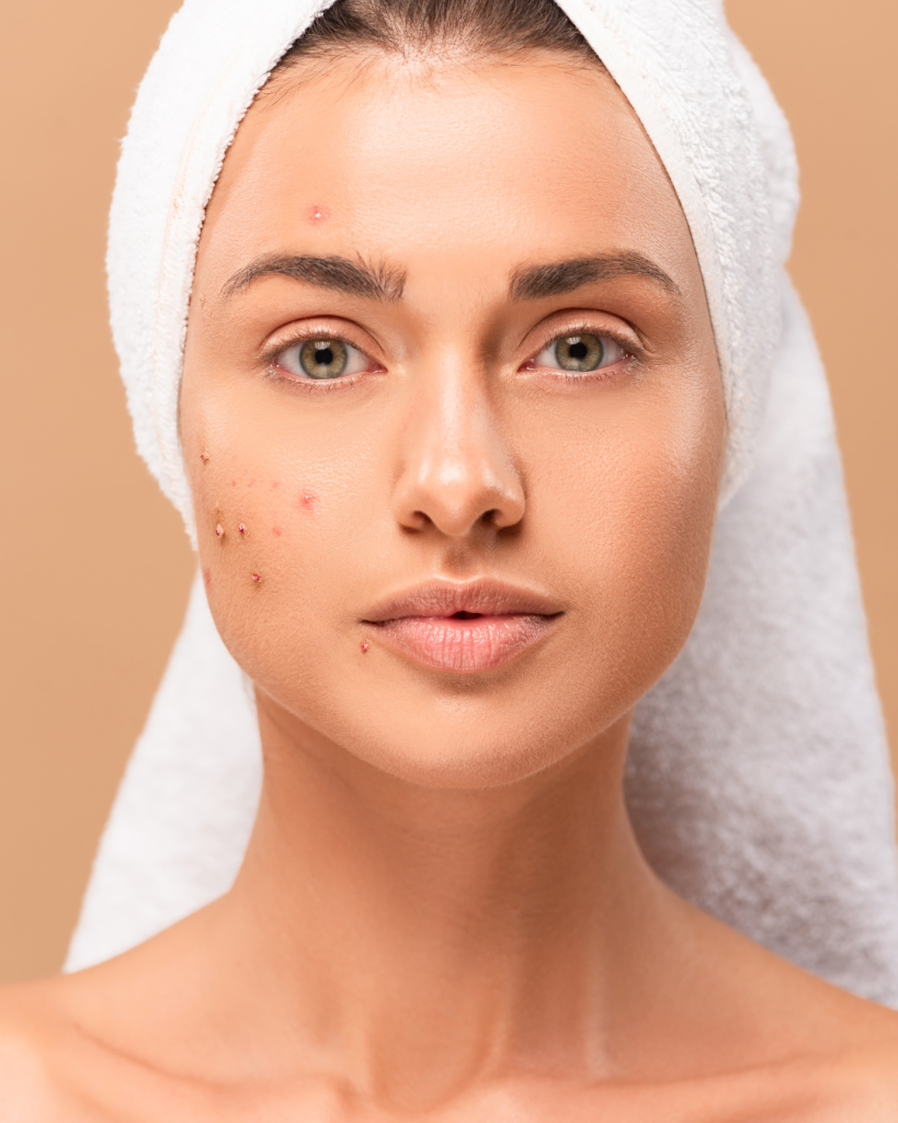 Woman with towel head wrap showing fungal acne spots on cheeks and forehead.