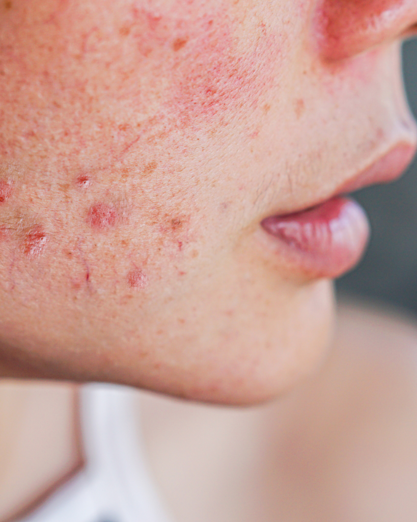 Side view of face with inflamed red acne and post-acne marks on cheek and jawline