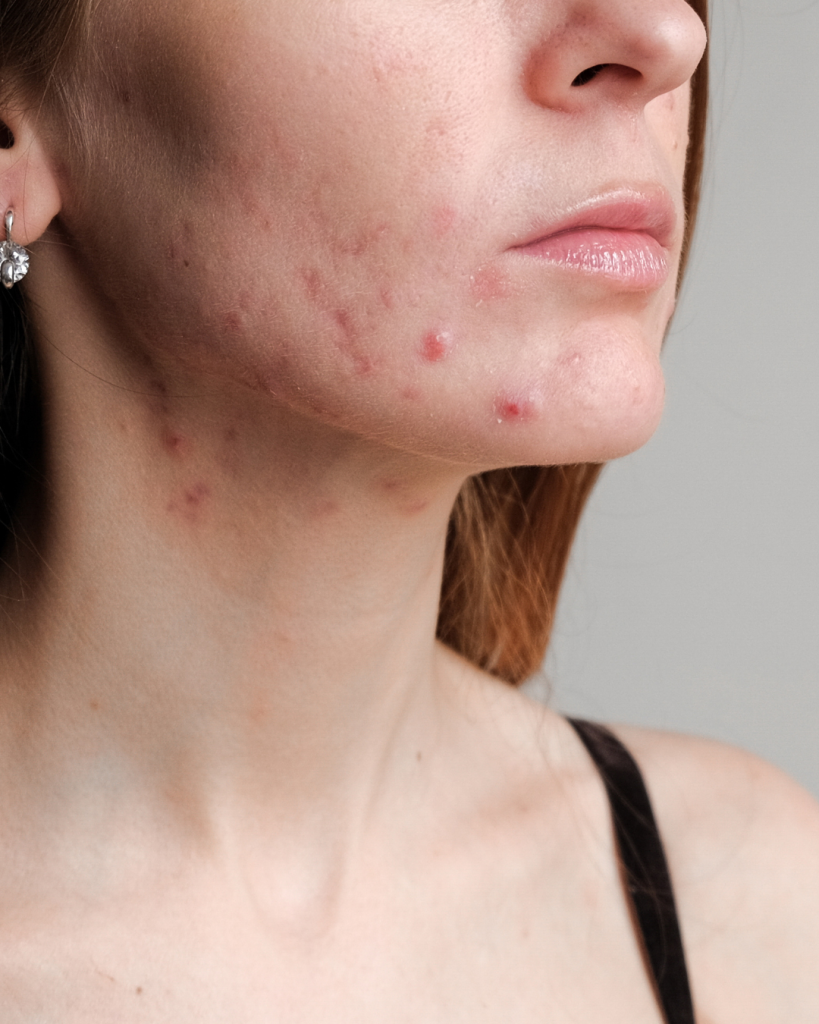 Moderate acne with pustules and nodules on jawline and chin of young woman