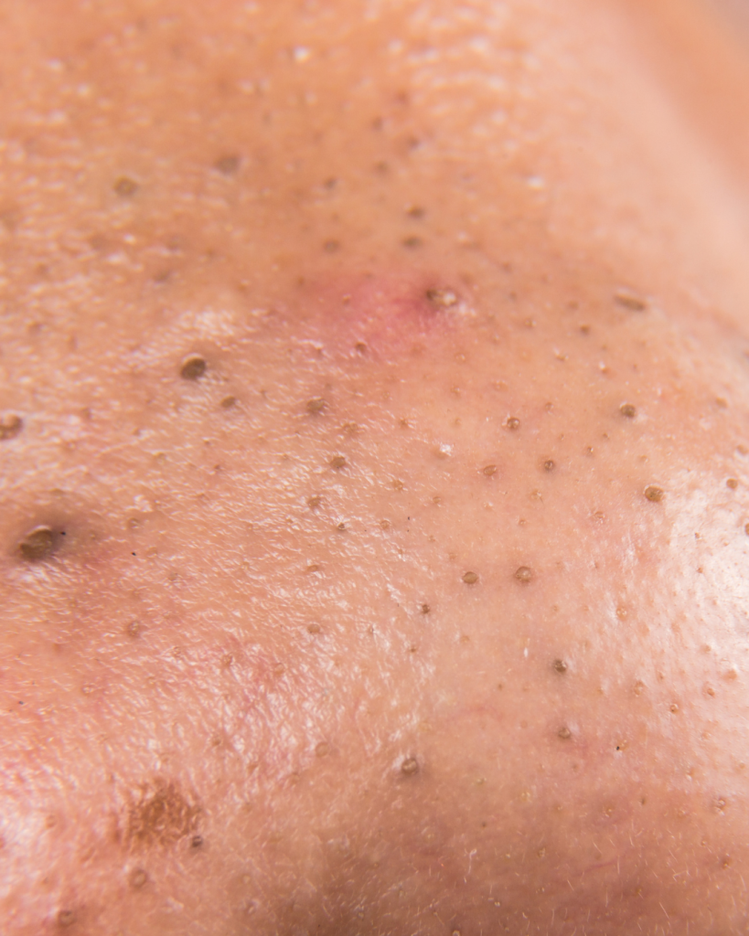 Close-up of blackheads and clogged pores on skin surface around nose area
