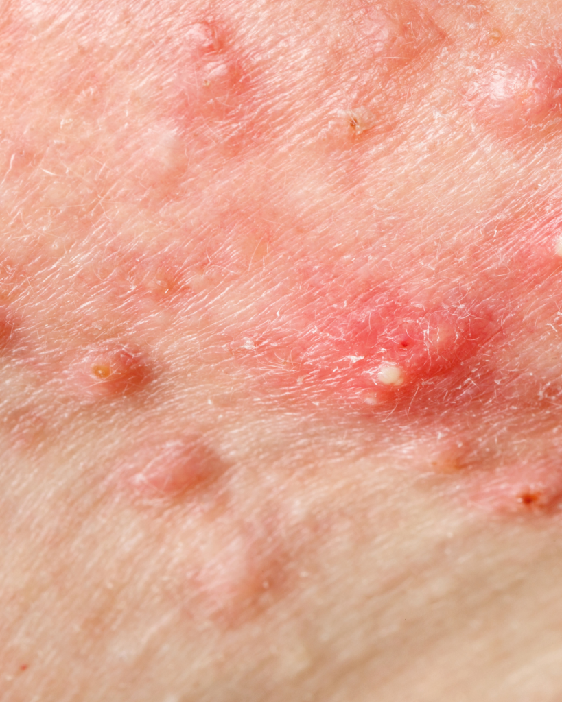 Close-up of papules and pustules acne on cheek with visible redness and inflammation