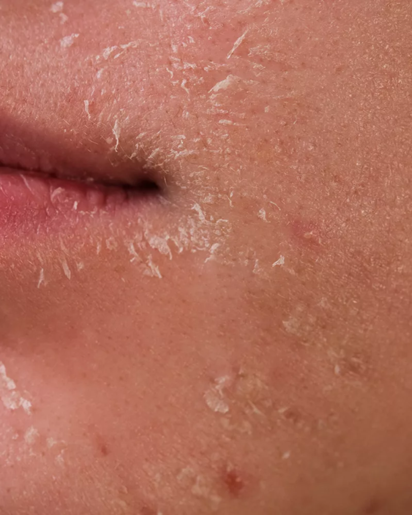Macro shot of dehydrated skin texture before facial treatment