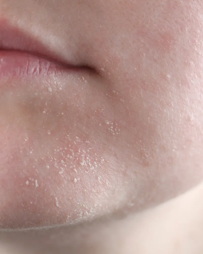 Dry skin on face highlighting lack of moisture and dull tone