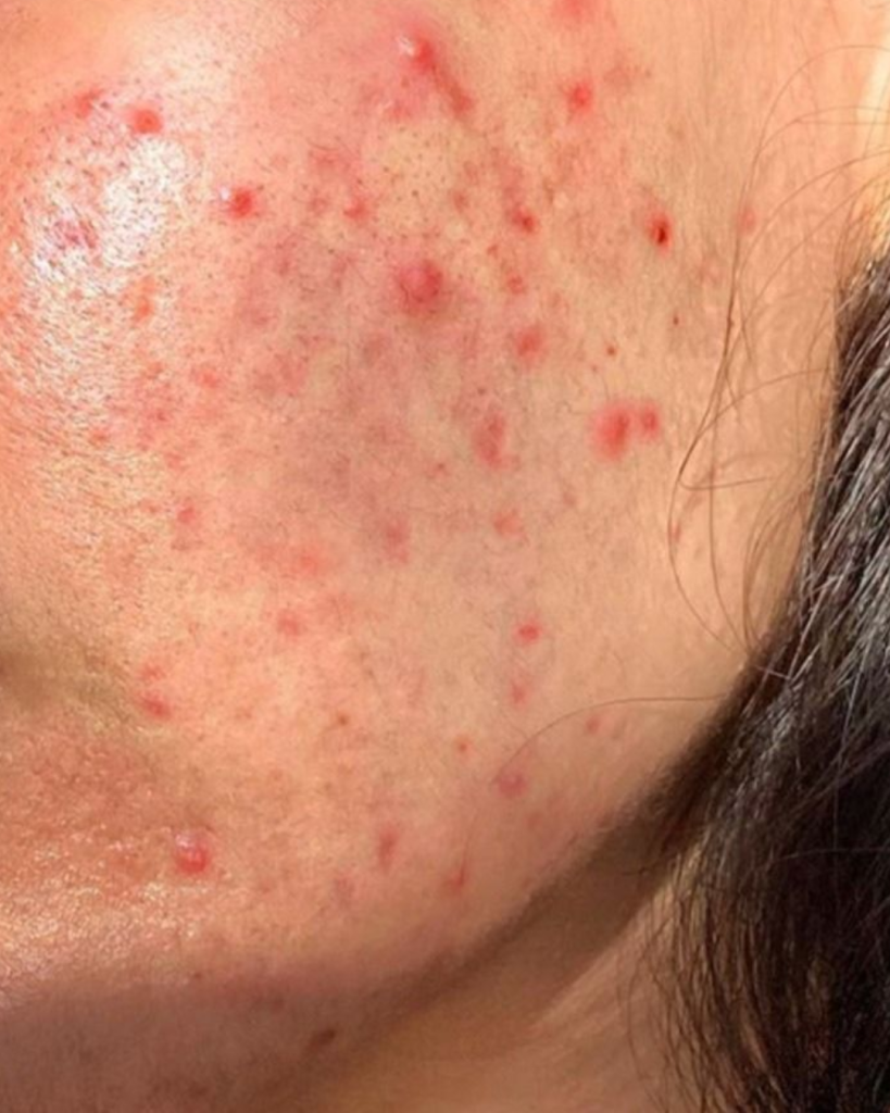 Inflamed cystic pimples caused by hormonal acne