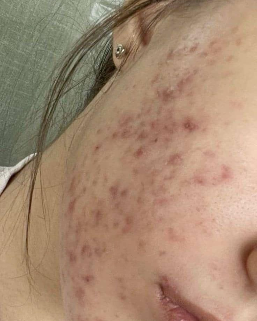 Hormonal acne breakouts on lower cheeks and jawline