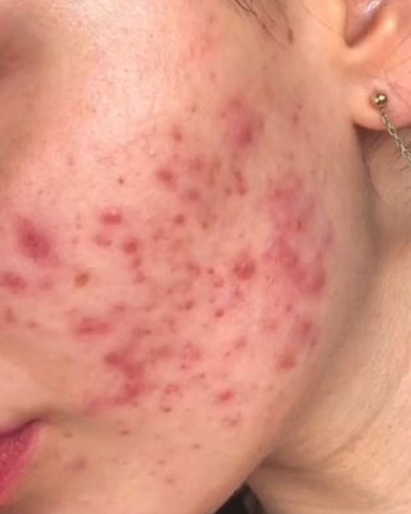 Red, irritated skin with hormonal acne nodules