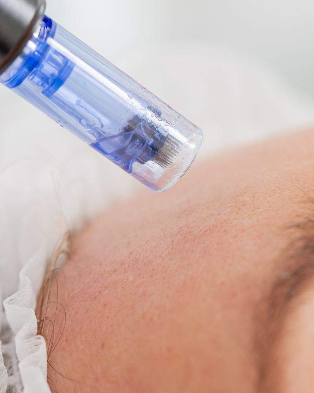 aftercare microneedling